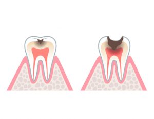 hinboca clínica dental, tratamientos dentales, endodoncia