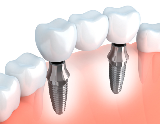 hinboca clinica dental, tratamientos dentales, implantes dentales