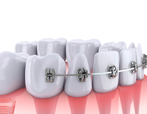 hinboca clínica dental, tratamientos dentales, ortodoncia