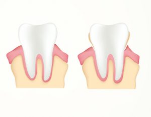 hinboca clinica dental, tratamientos dentales periodoncia