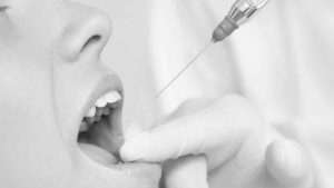 dentista en Aluche tipos de anestesia