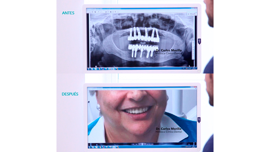 implantes dentales de calidad