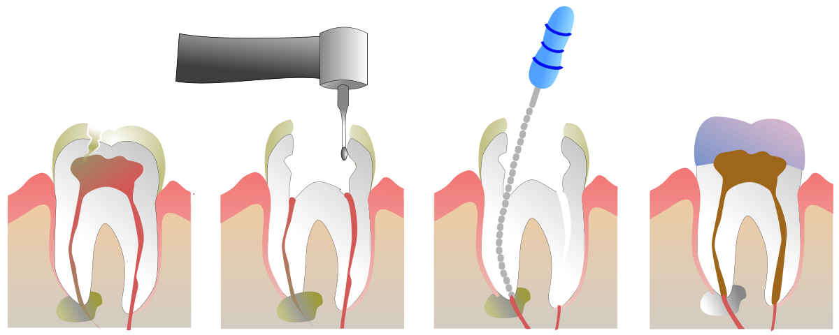 endodoncia en madrid