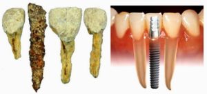 Evolución de la odontología.Implantes dentales en Aluche