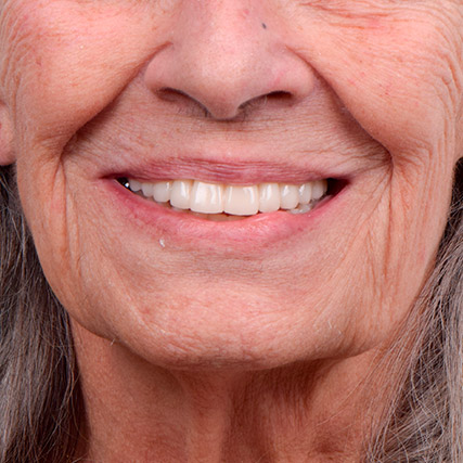 caso-implantes-dentales-hinboca-1