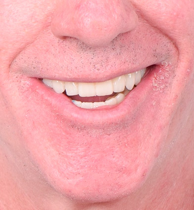 caso-implantes-dentales-hinboca-3