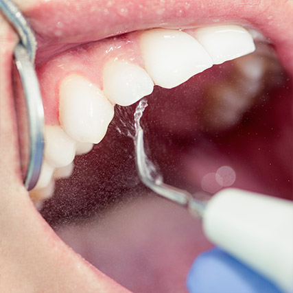 periodoncia-hinboca-1